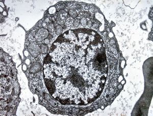 F,61y. | blood - lymphoplasmocellular leukemia